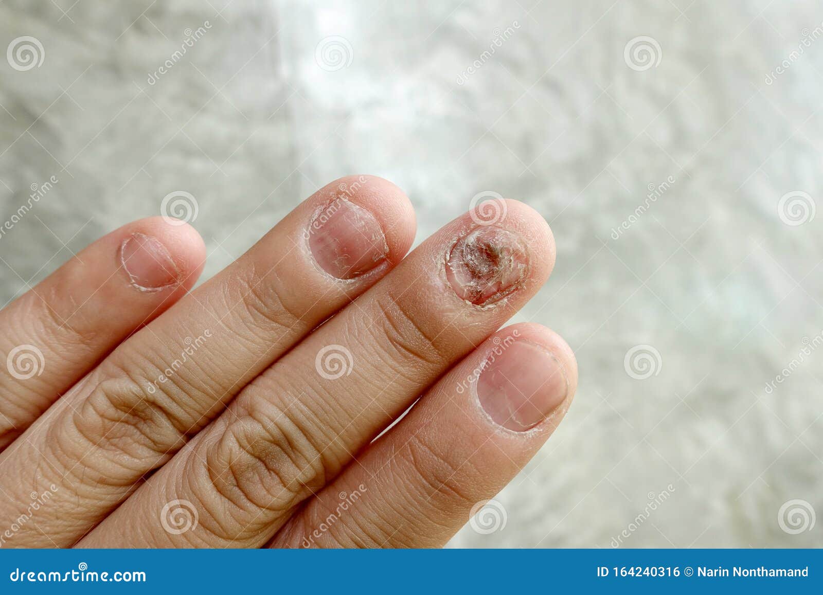 Photo of Index Finger of Right Hand with Fungus on the Nail Stock Photo -  Image of involvement, index: 298558034