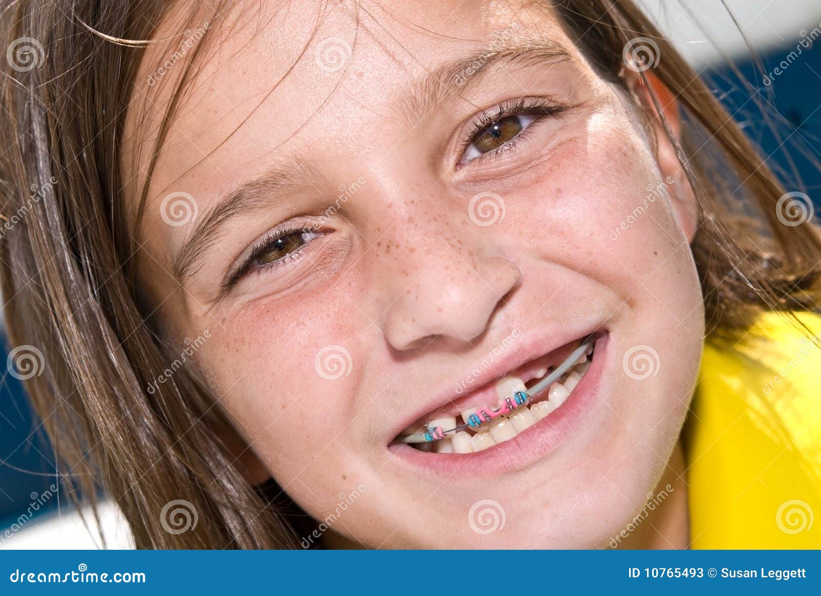 Pictures Of Girls With Braces