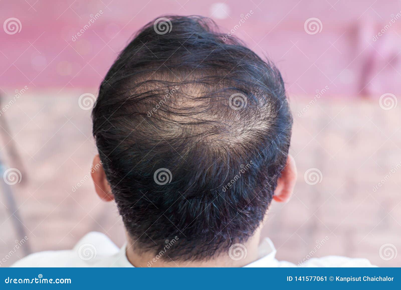 Close Up Hair Loss, Thinning Hair and Scalp Issue. Hair Loss with Loss Symptoms. Bald Treatment Stock Image - Image of loss, issue: 141577061 Close Up Hair Loss, Thinning Hair and Scalp Issue. Hair Loss with Loss Symptoms. Bald Treatment Stock Image - Image of loss, issue: 141577061