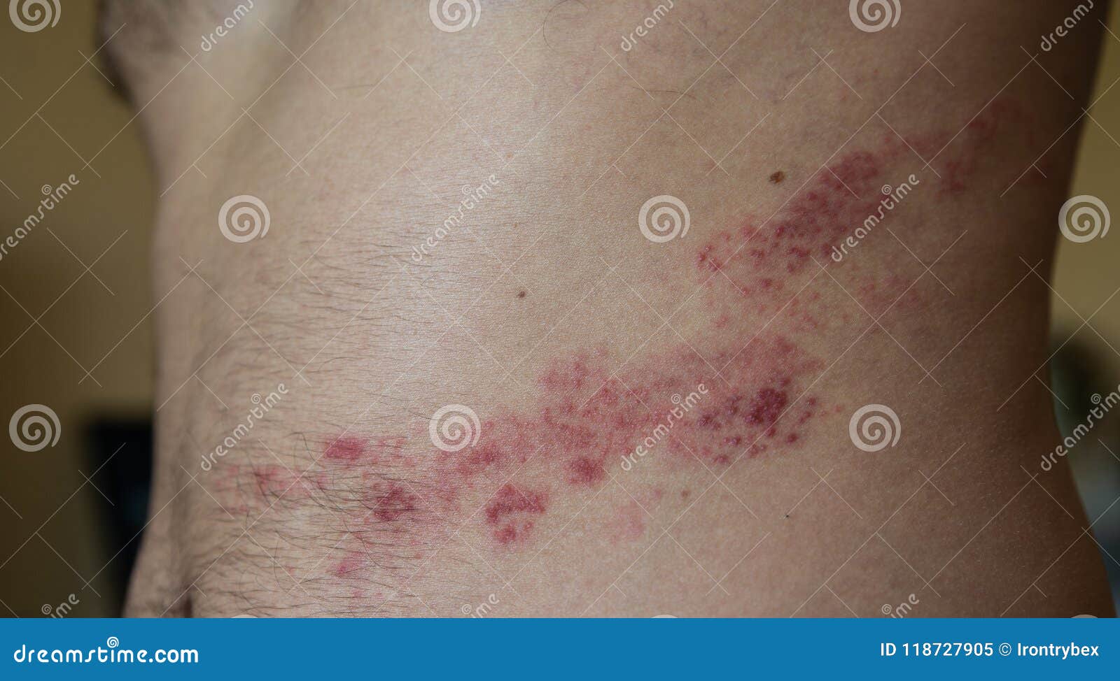 Close Up on Herpes Zoster on the Stomach Stock Image Image of illness