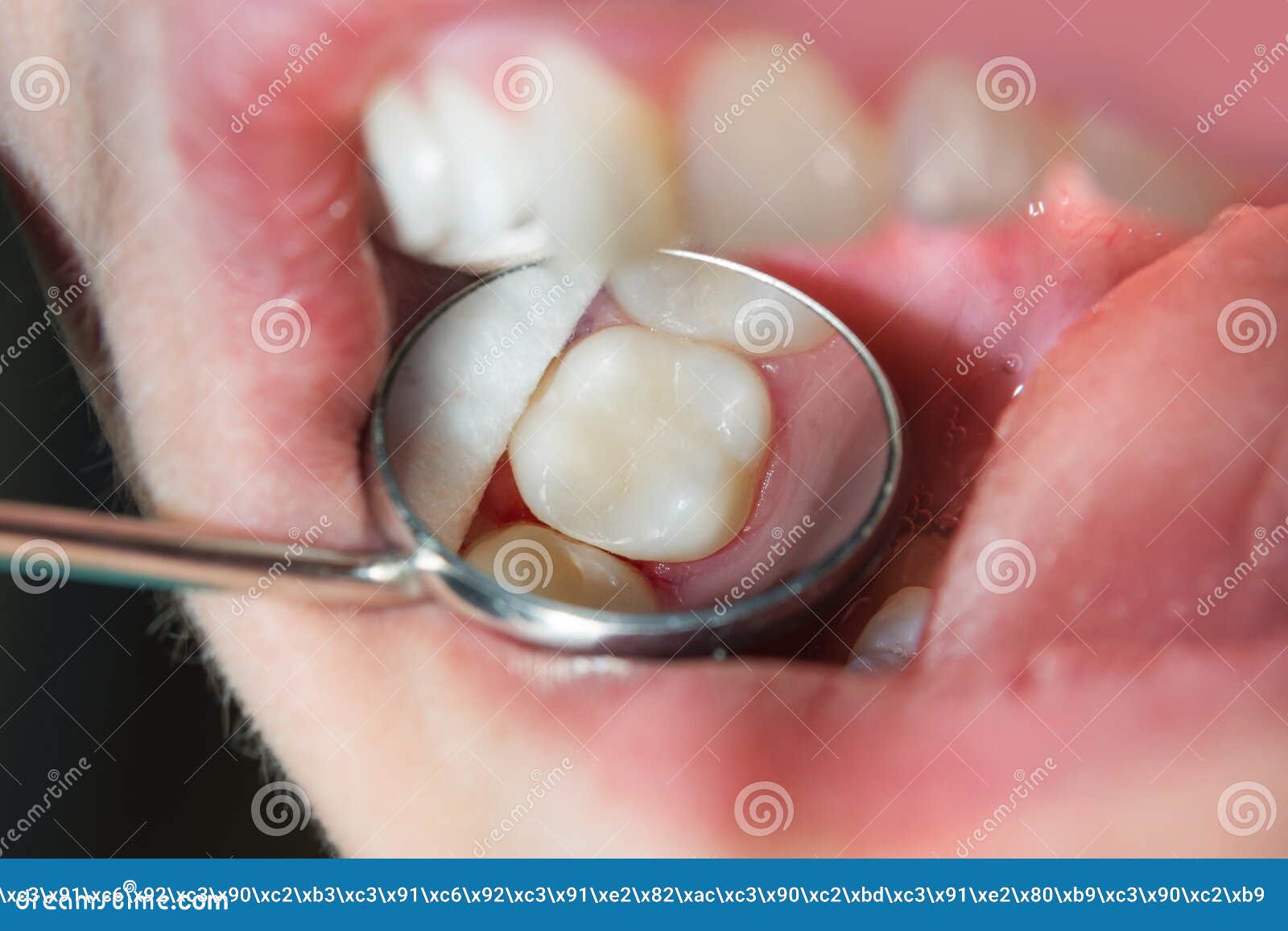 close-up of a human rotten carious tooth at the treatment stage