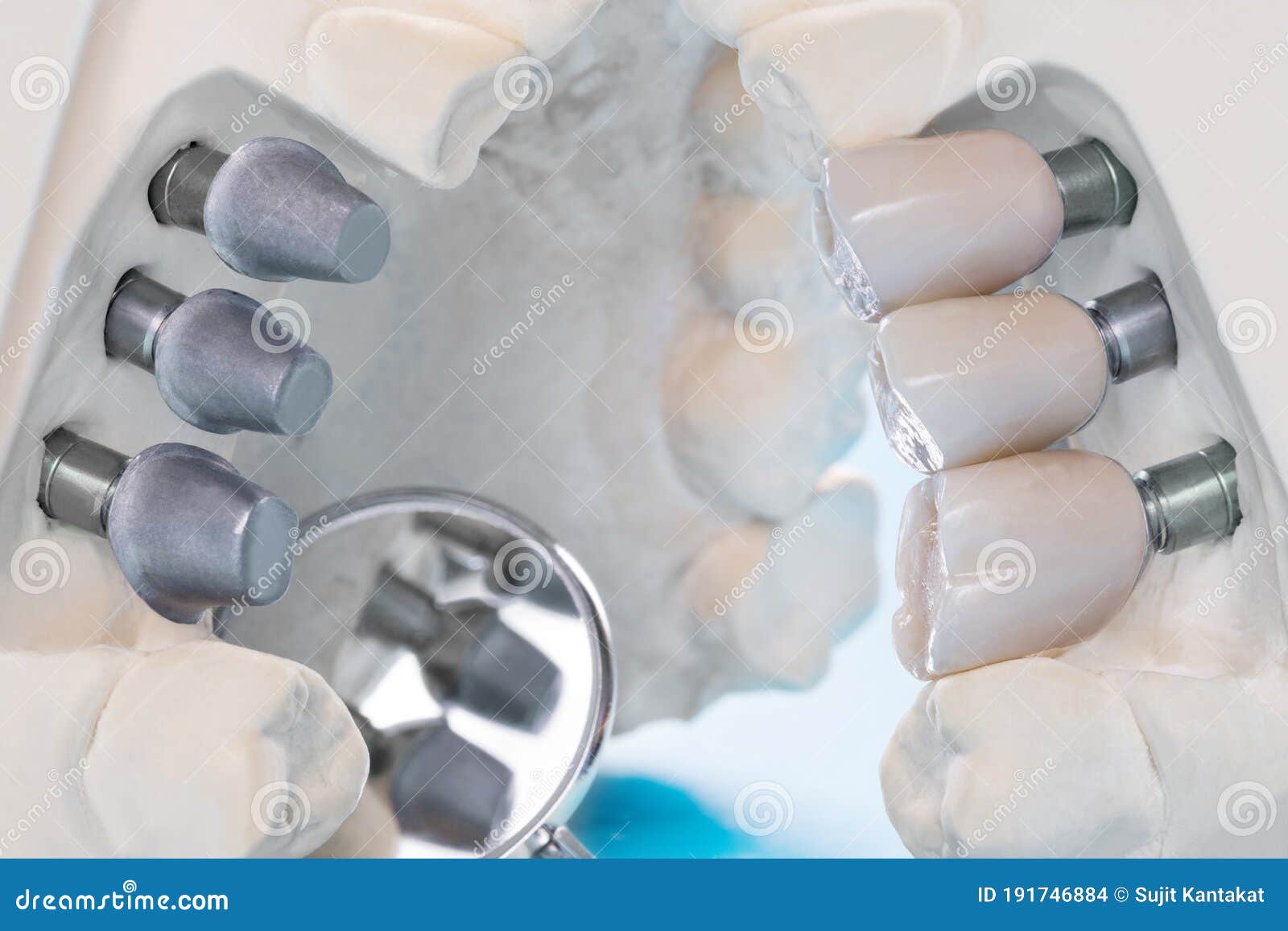 Close Up Implant and Prosthodontic Model. Stock Photo Image of medical, dentist 191746884