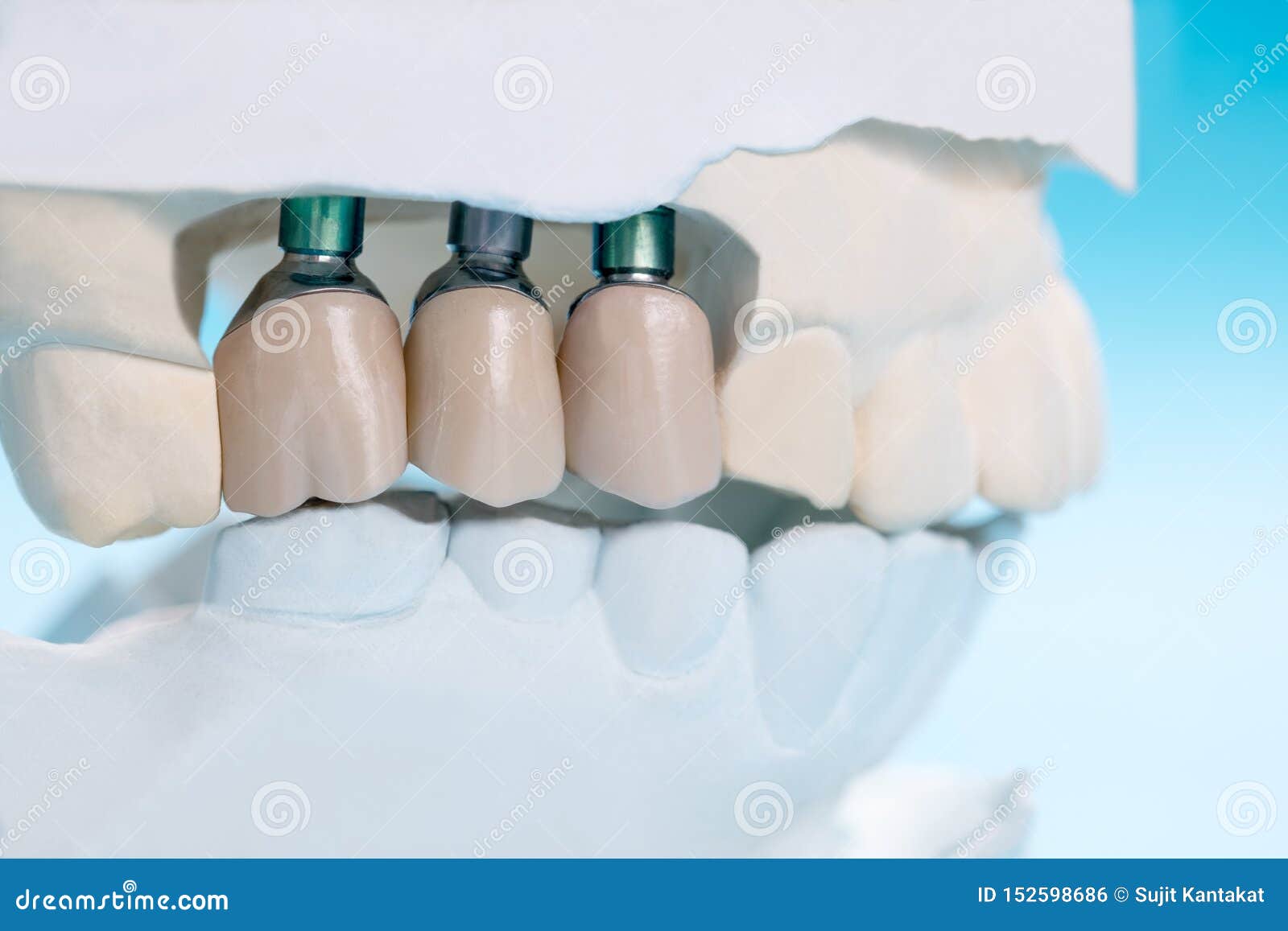 Close Up Implant and Prosthodontic Model. Stock Photo Image of dentistry, surgery 152598686