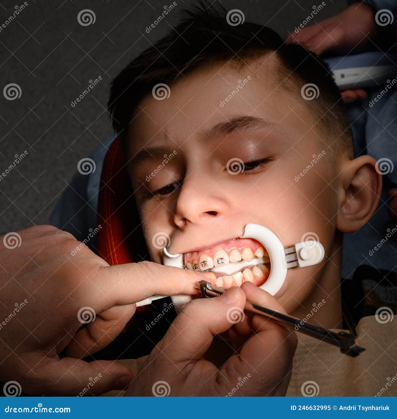 Close Up of Installing Braces on Teeth, Aligning Teeth with Braces
