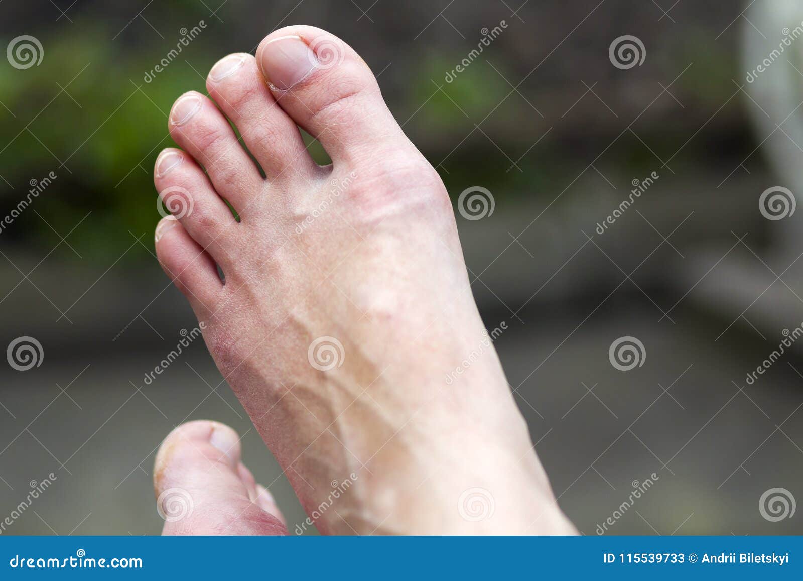 10 Ways to Prevent Toenail Fungus in North Seattle | Foot and Ankle Center  of Lake City