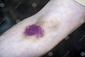 Bruise From Injection Stock Image CartoonDealer 102289681