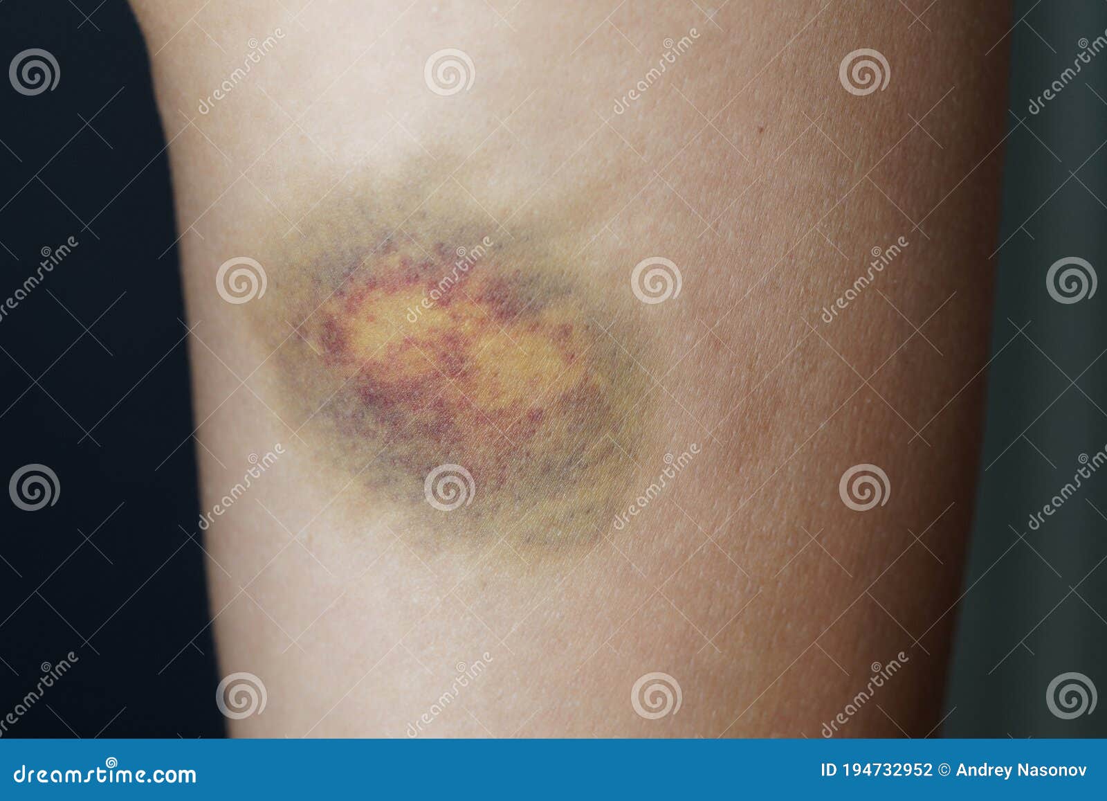 A Large Bruise On A Woman`s Leg Stock Photo Image Of Woman Blue