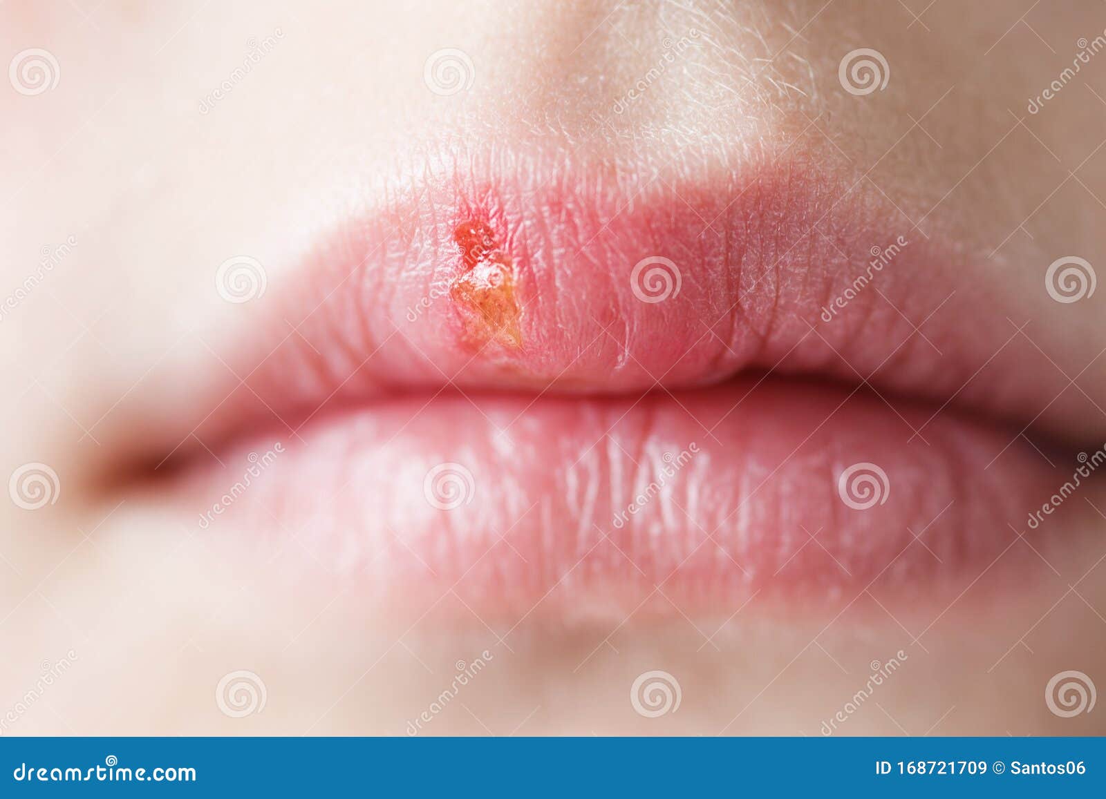 Herpes simplex stock image. Image of closeup, female 168721709