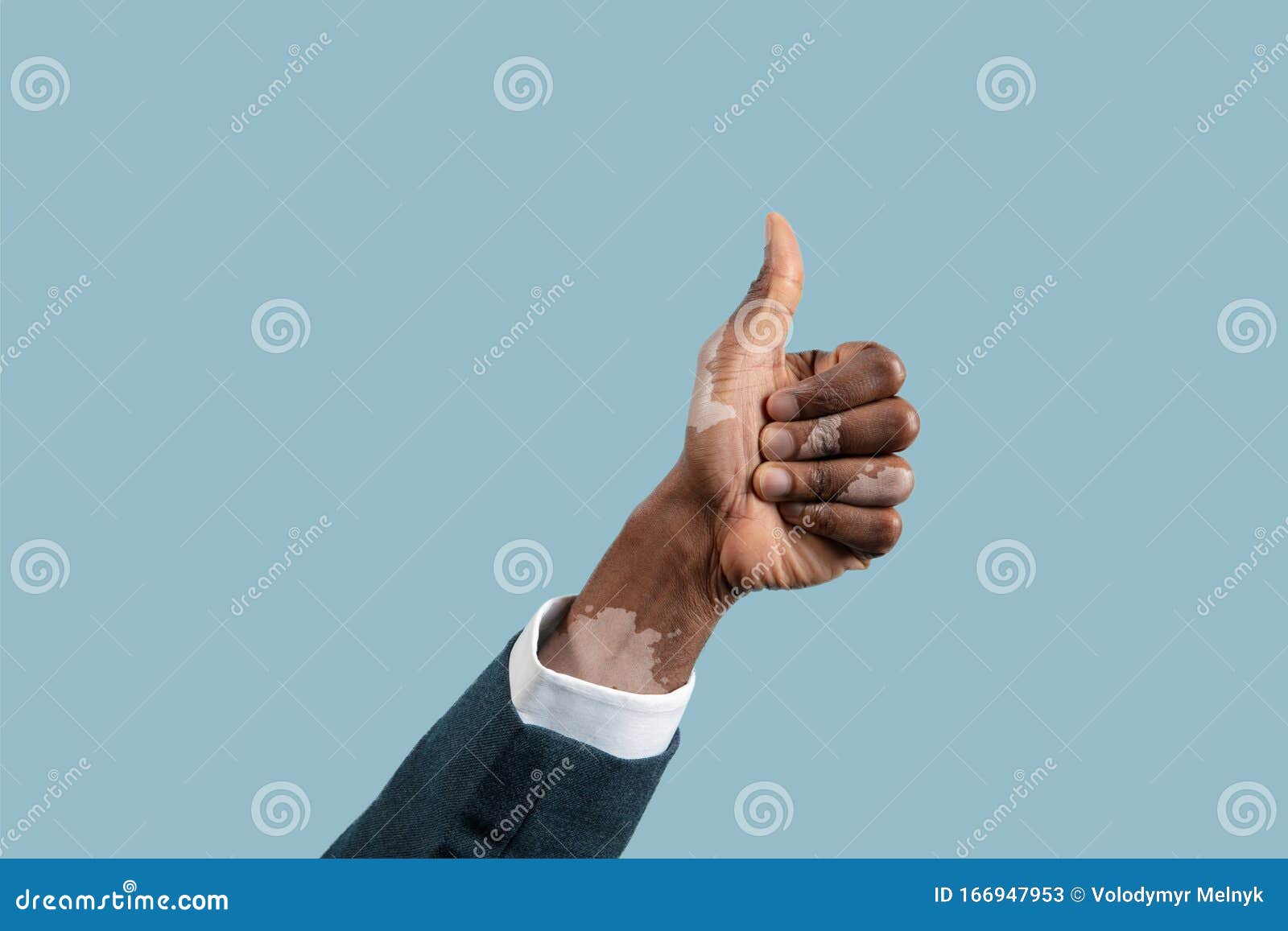 close up of male hands with vitiligo pigments  on blue studio background