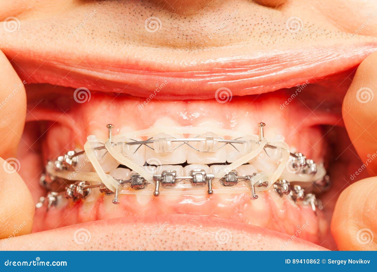 Man's mouth with braces and rubber correction strings on dental hooks  fixing position of teeth Stock Photo - Alamy