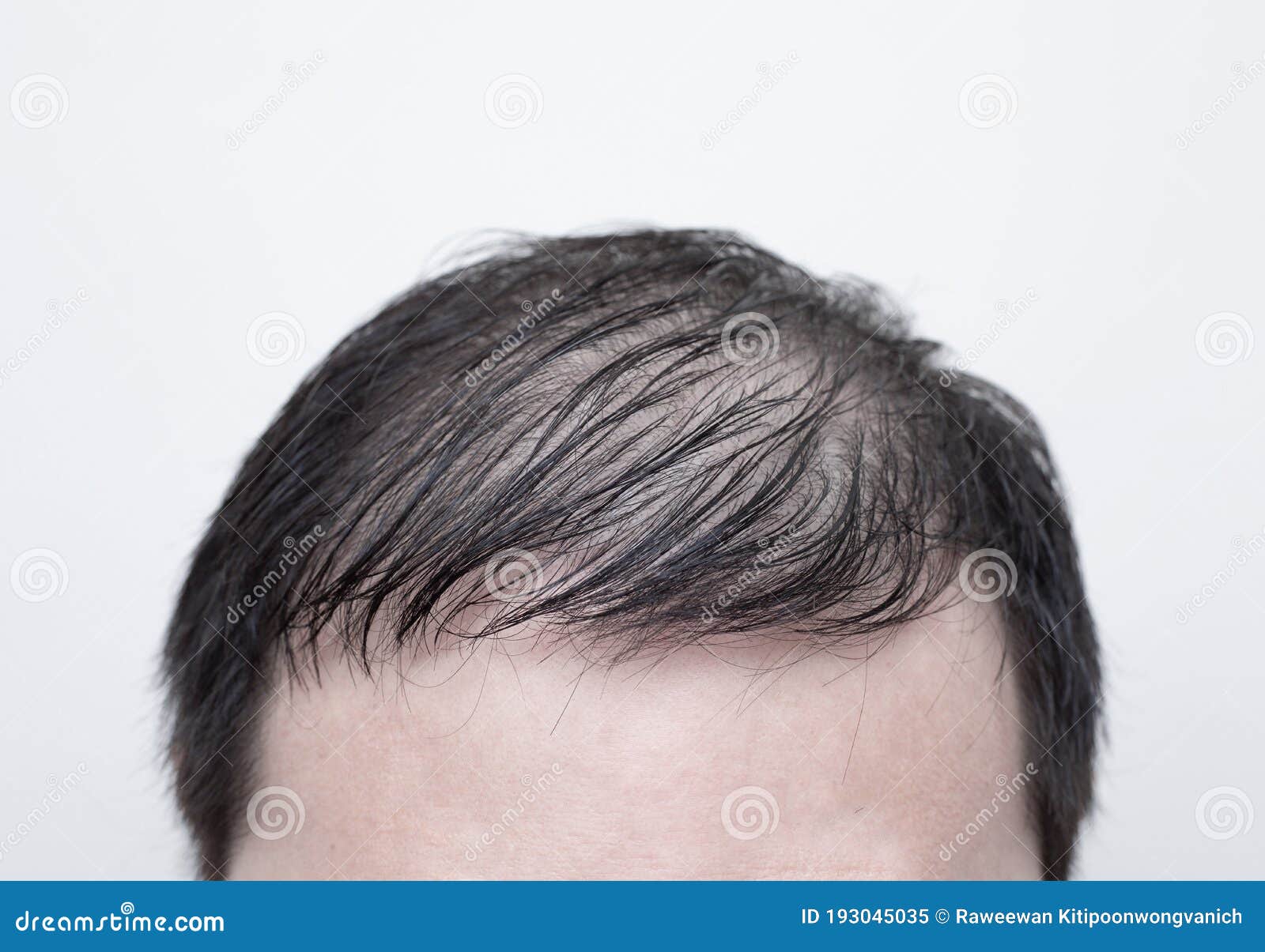 Close Up Man`s Head with Hair Loss, Thinning Hair or Alopecia Isolated on  White Background. Hair Problem Stock Image - Image of illness, asian:  193045035