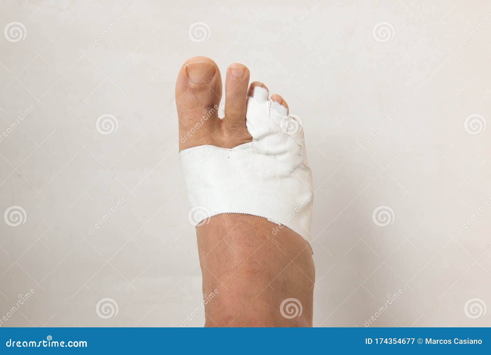 Mans Bandaged Up Broken Toe Stock Image Image of digit, bandages