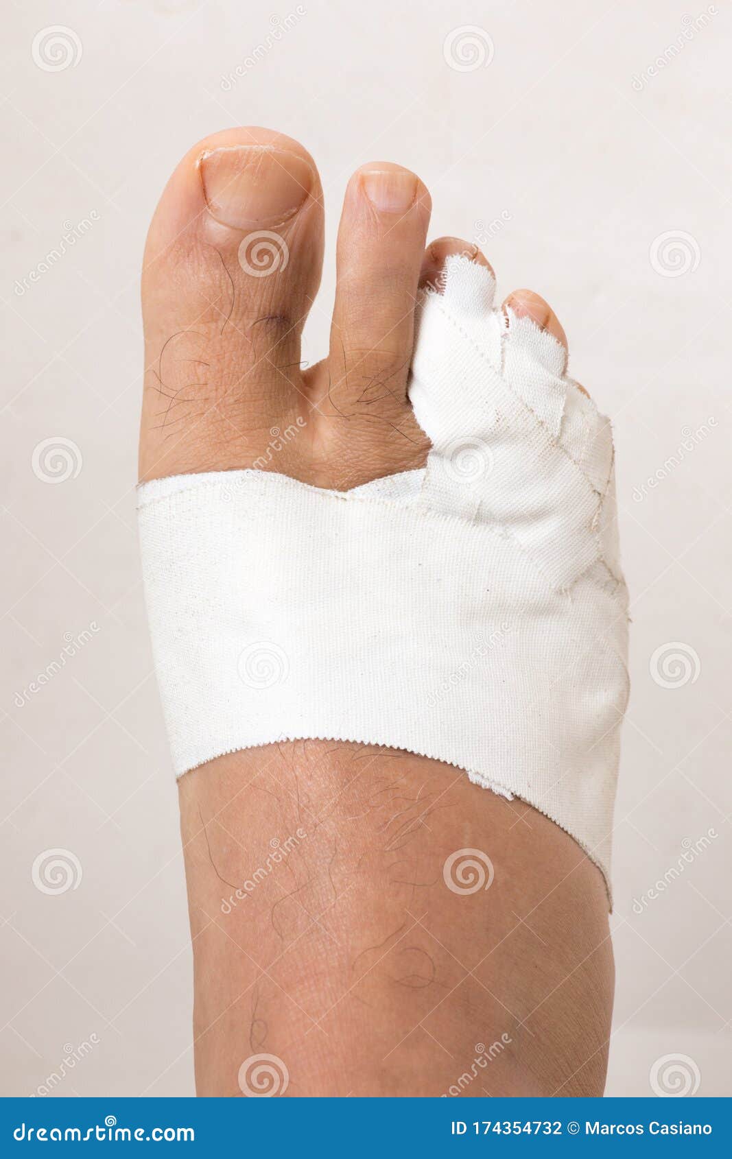 Mans Bandaged Up Broken Toe Stock Photo Image of aging, joint 174354732