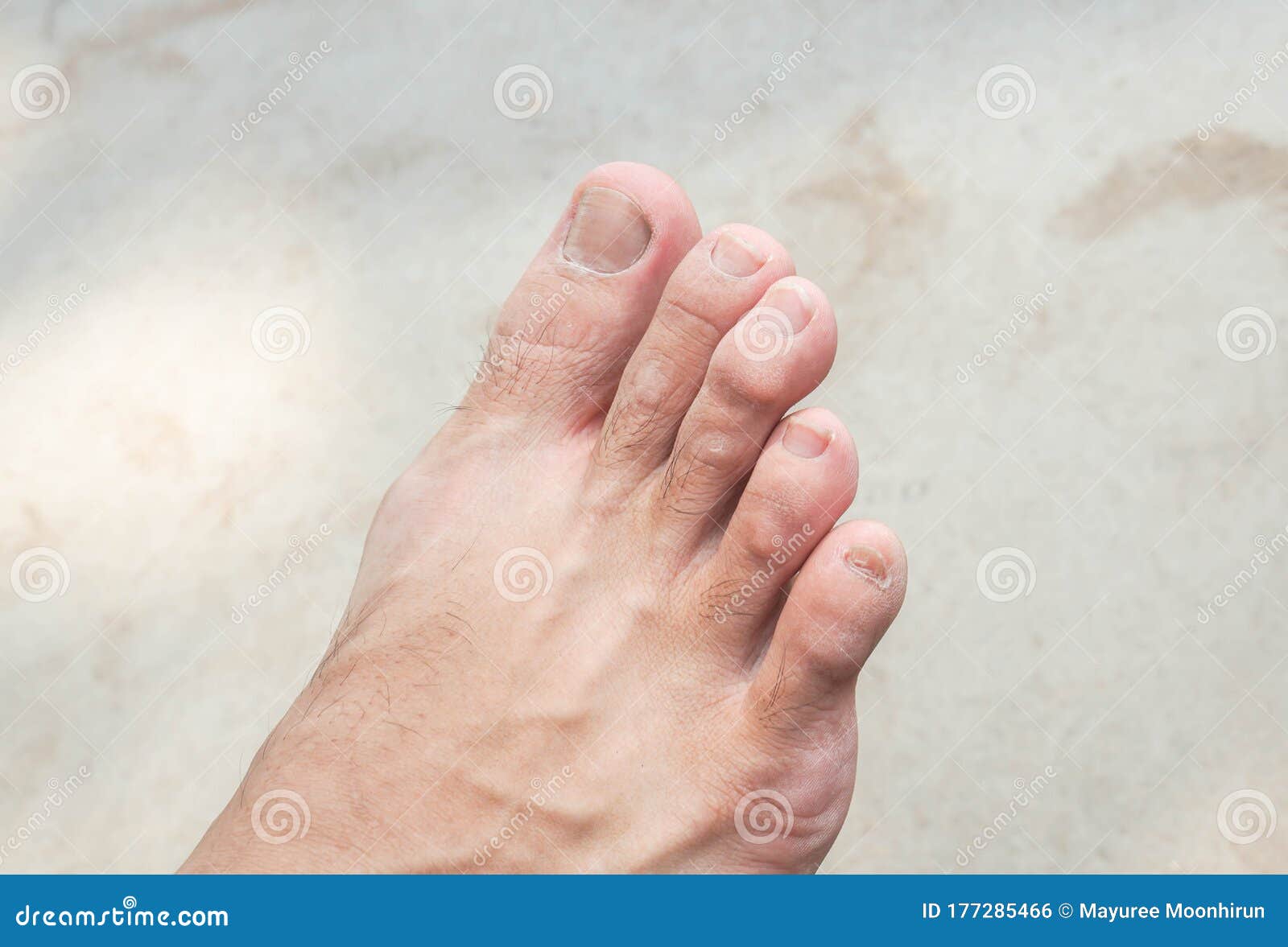 Types of Toenail Fungus: Pictures, Symptoms, and Treatment