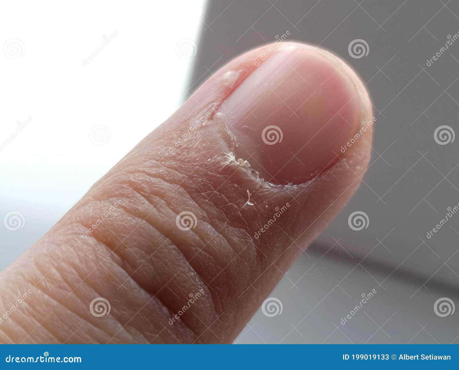 close up of my index fingers with dry, cracked skin on cuticles, skin is torn and flaking off.