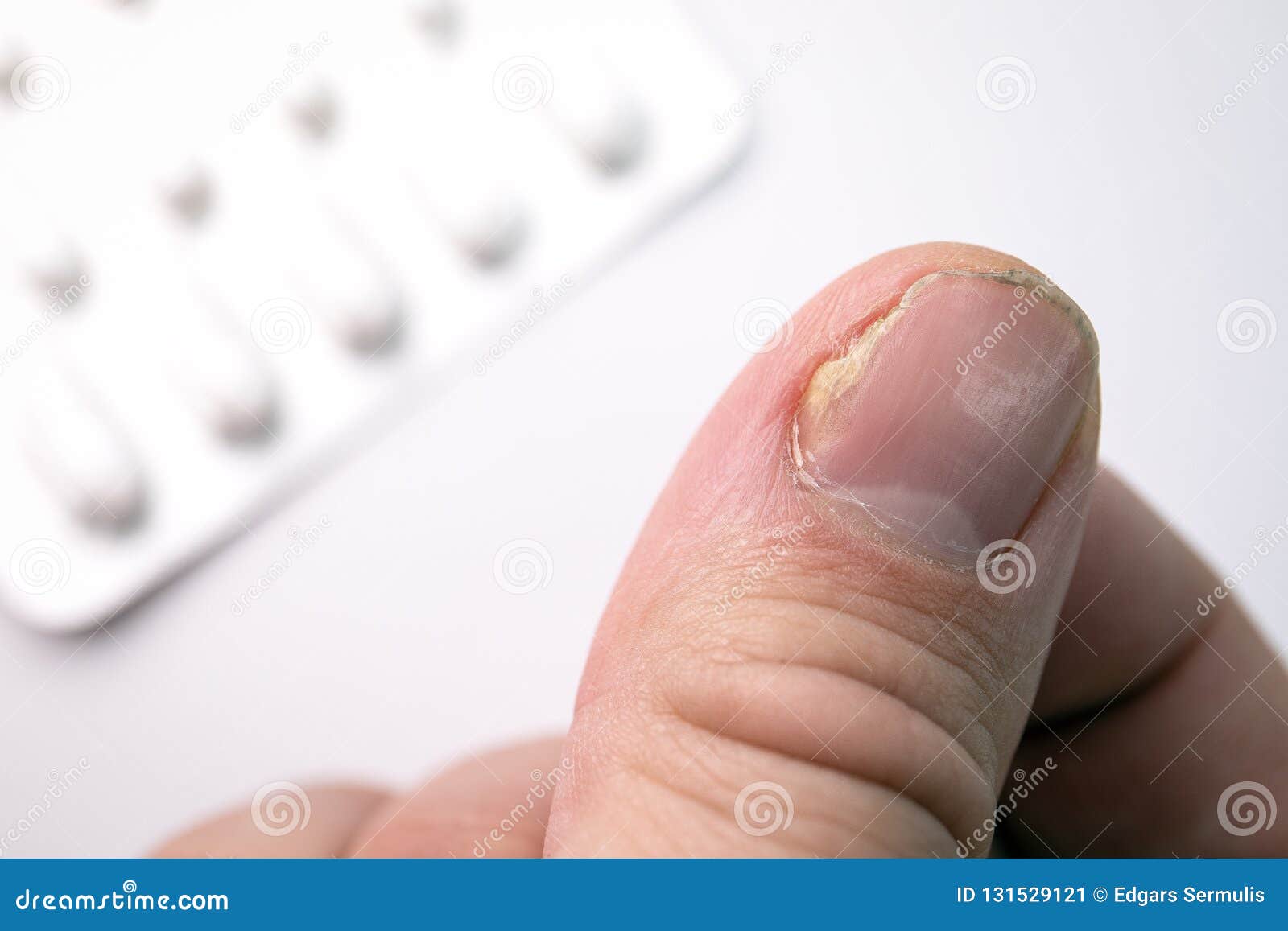 Close up of fungus nail infection. Fungal infection on nails hand, finger  with onychomycosis, damage on human hand on gray concrete wall background.  Disease and Symptom concept. Stock Photo | Adobe Stock