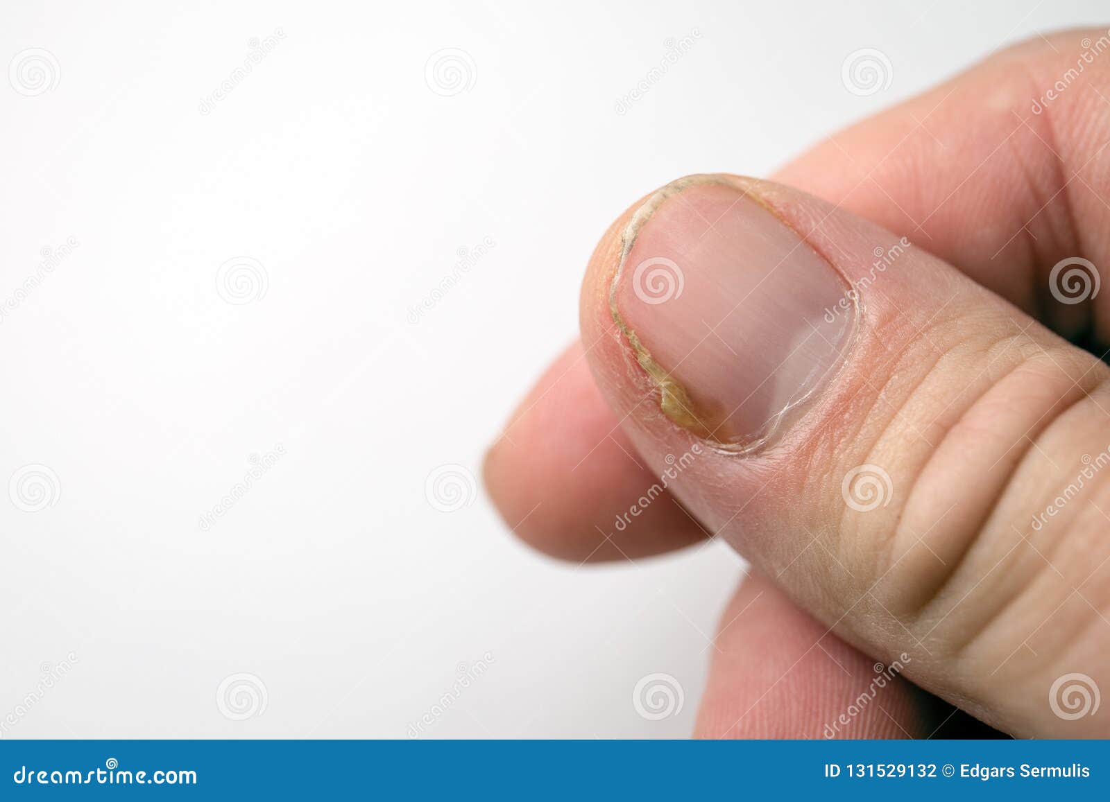 Close-up Fungal Fingernails on the White Background.Macro View Single Finger  Nail Damaged by Infection Soft Focus Stock Photo - Image of health, single:  250371146