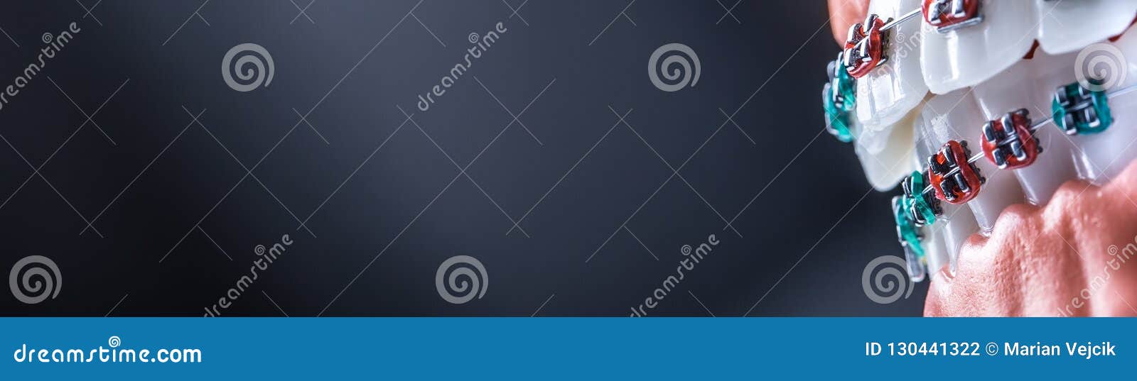 Closeup of a Orthodontic Model Jaws and Teeth with Braces Stock Photo