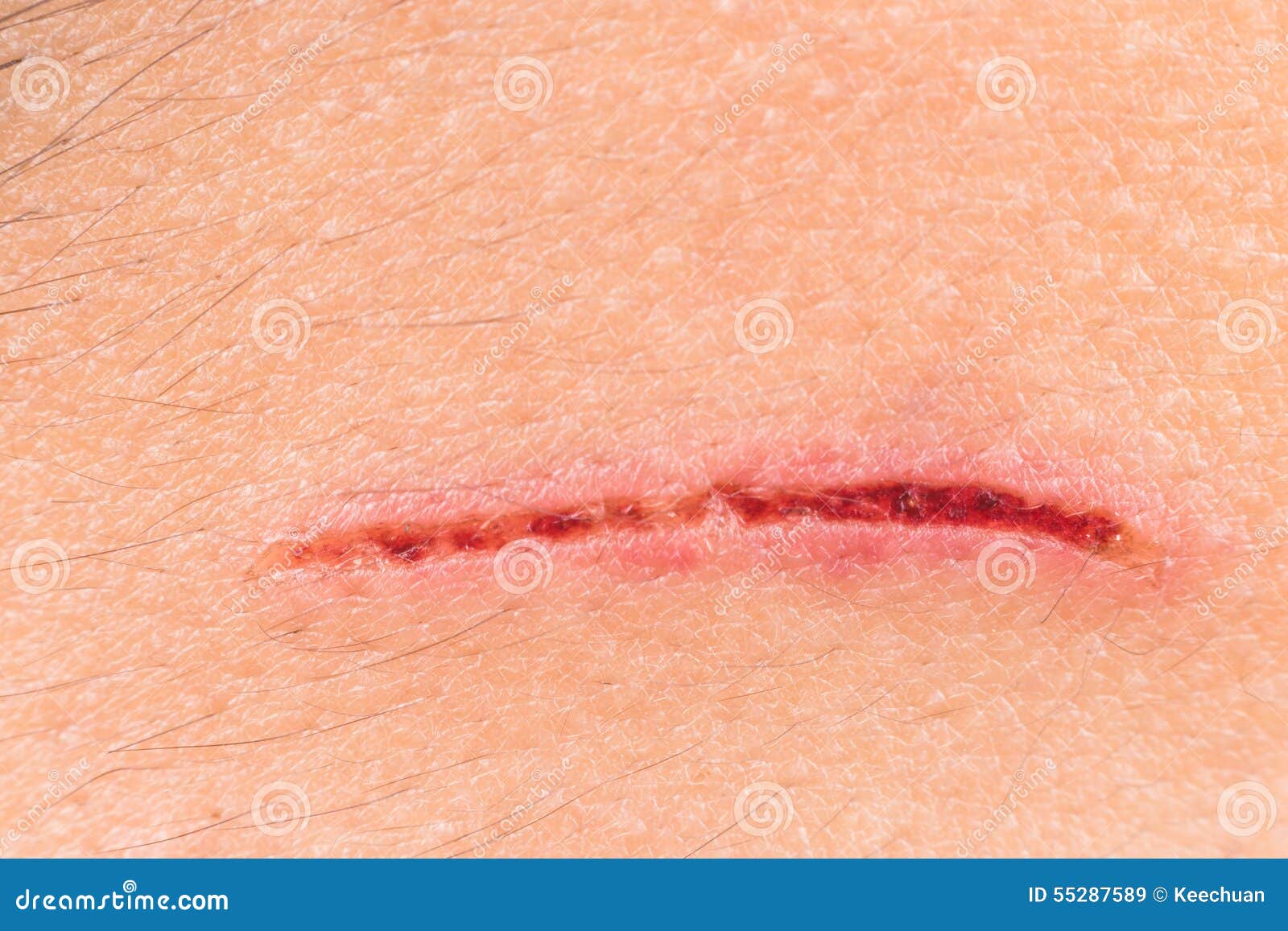 Close Up of Painful Wound on Forehead from Deep Cut Stock Image Image