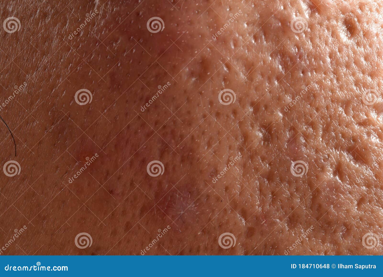 Close Up Photo Of Nodular Cystic Acne Skin Photo Stock Image Du