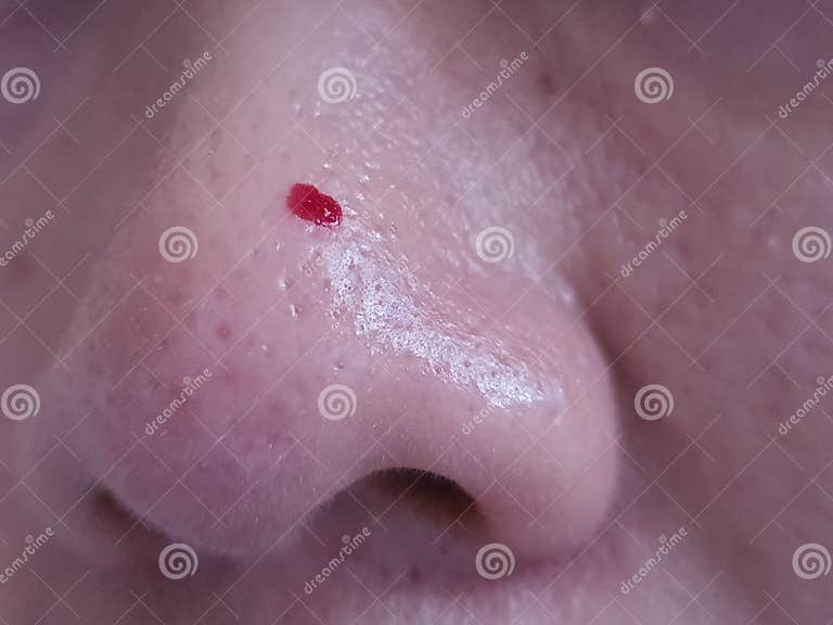 Close Up Picture of Bleeding from Popping Blackheads on the Nose