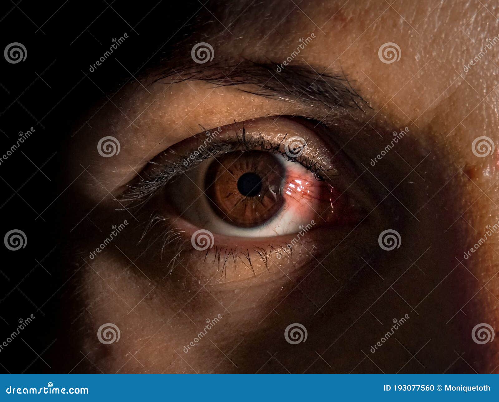 close-up of a pterygium or surfer`s eye growing onto the cornea eye