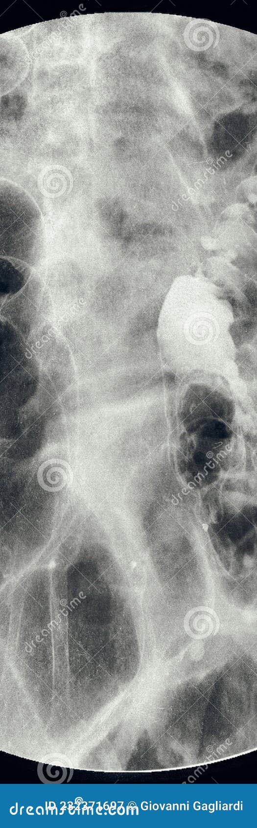 Close Up Xray Barium Enema Examination. Colorectal Xray Stock Image