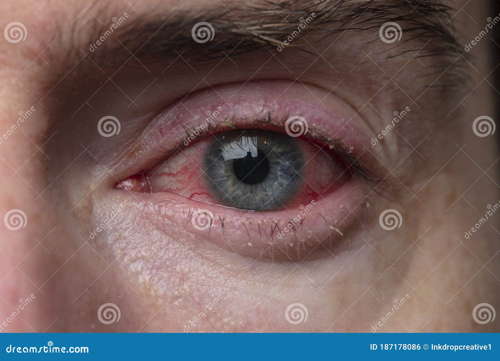 Blood Vessel Eyeball Intraocular Pressure Bloodshot Eyes, 53 OFF
