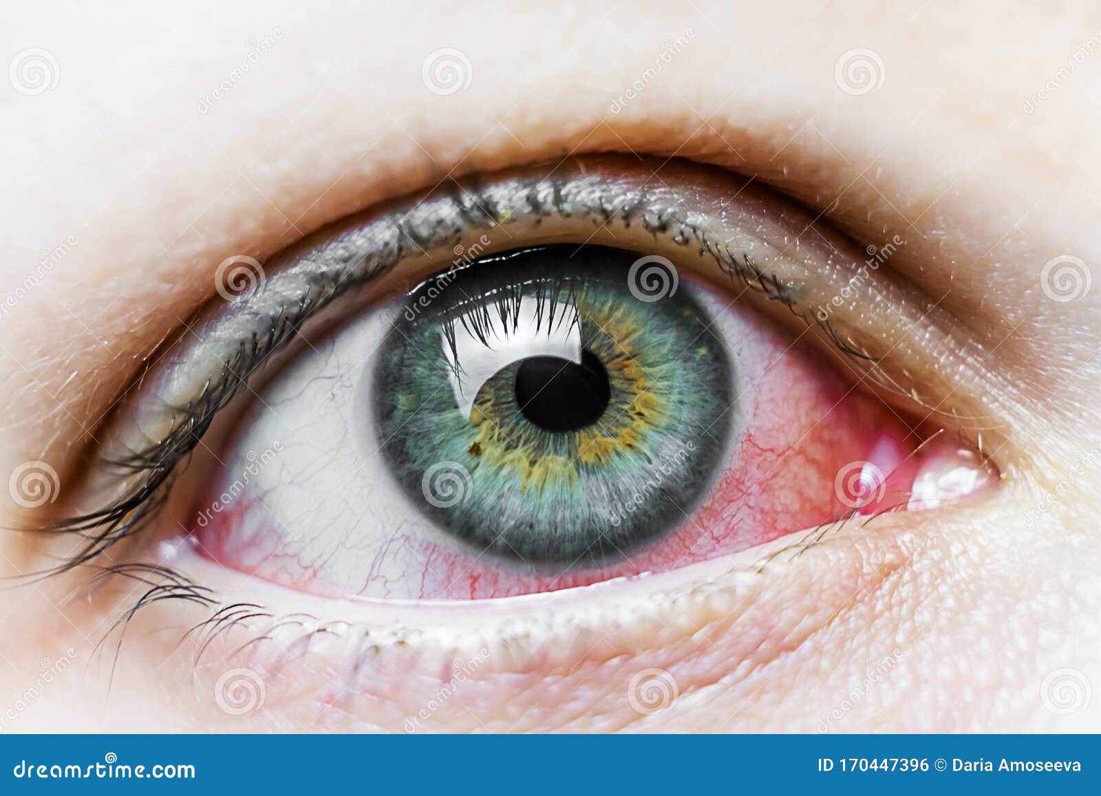 Close Up of a Severe Bloodshot Red Eye. Viral Blepharitis