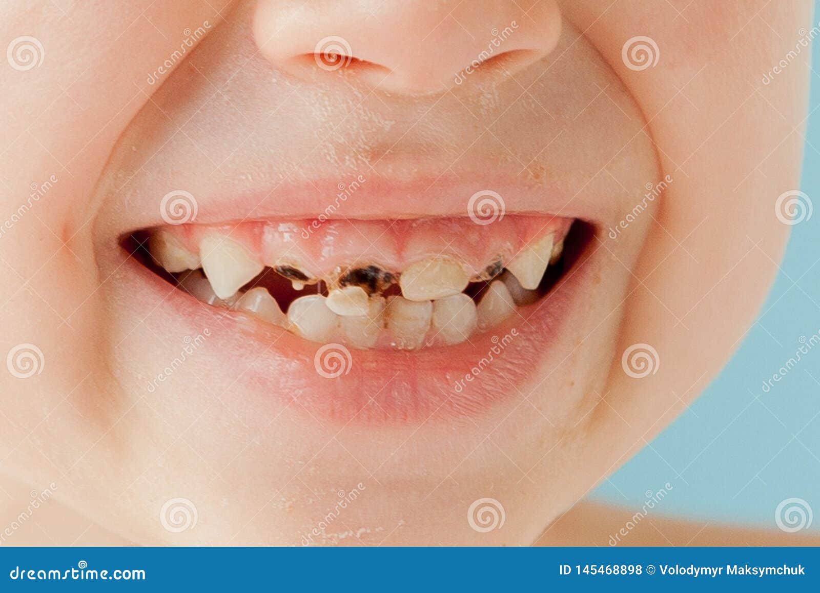close up shot of baby teeth with caries