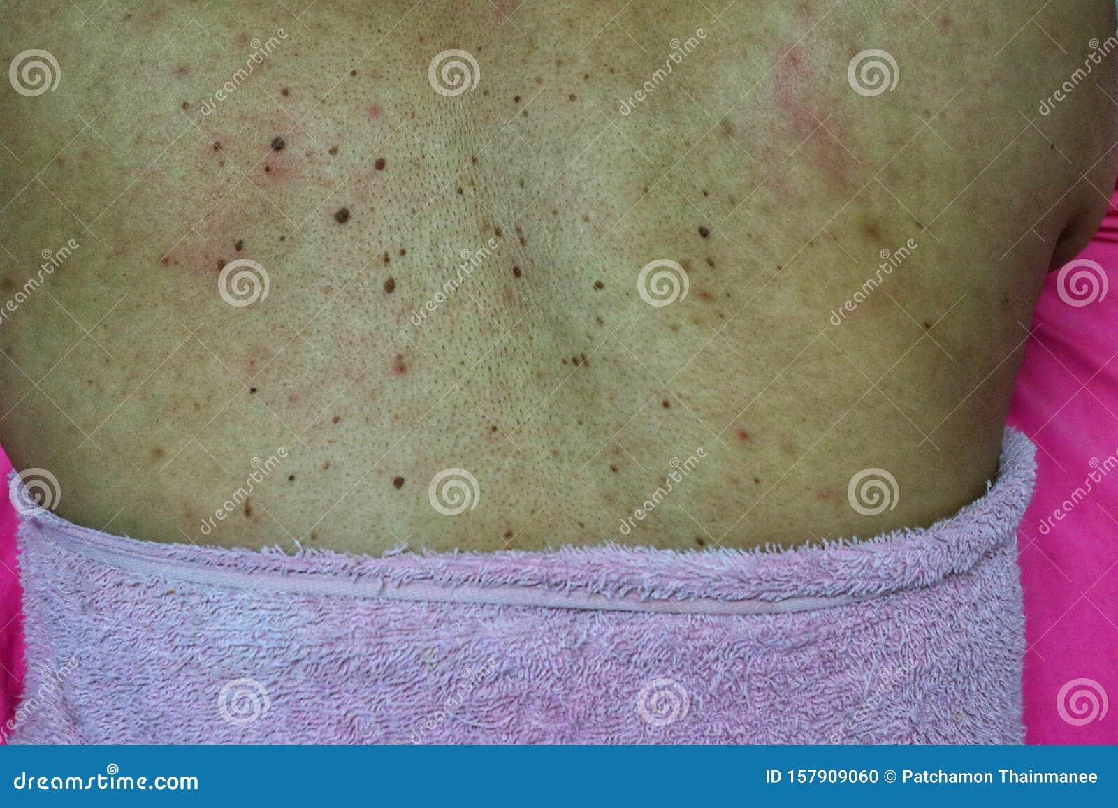 Close Up Of The Skin On The Back Of Women With Skin Diseases Allergies