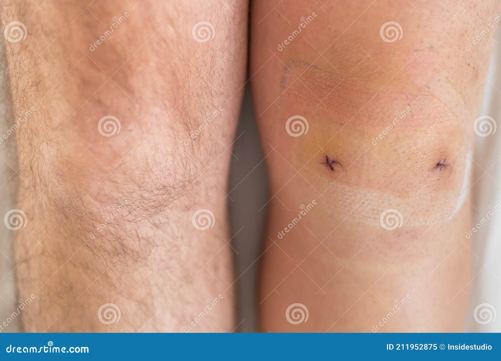 close-up of a surgical suture on the knee after laparoscopic minisk surgery. male legs after surgery