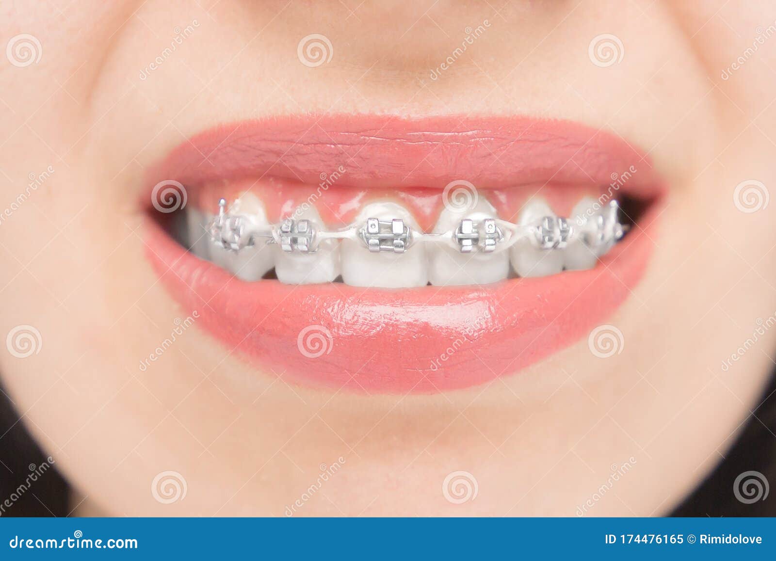 283 Braces Rubber Bands Stock Photos - Free & Royalty-Free Stock Photos  from Dreamstime