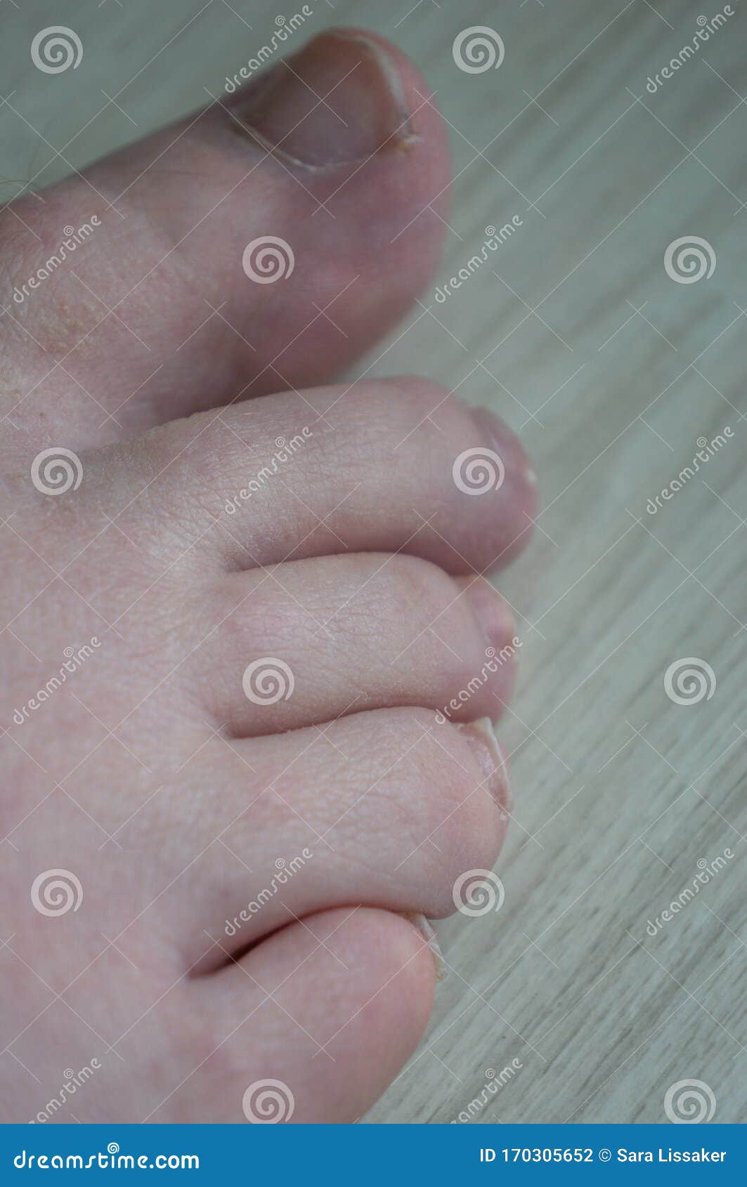 Close Up of Toes with Uncut Growing Toenails and Some Hair on Bigtoe. Small  Female Foot with Dirty Toenails and Bruised Toe from Stock Photo - Image of  disorder, cuticle: 170305652