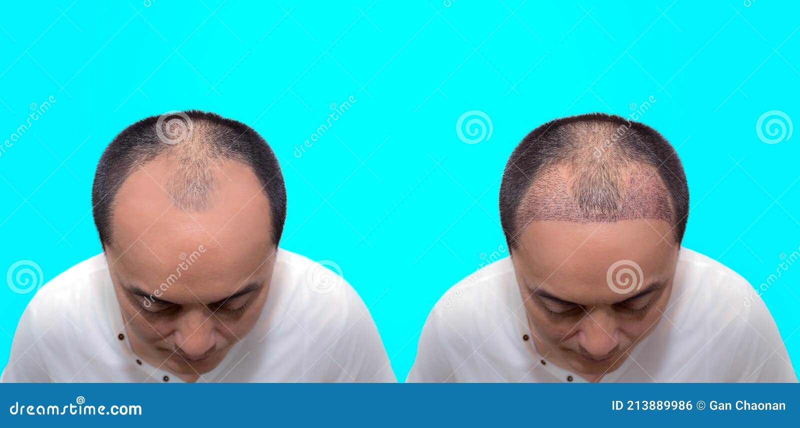 Close Up Top View of a Man`s Head with Hair Transplant Surgery with a Receding  Hair Line. before and after Bald Head of a Man Stock Photo - Image of  middle, hairline: