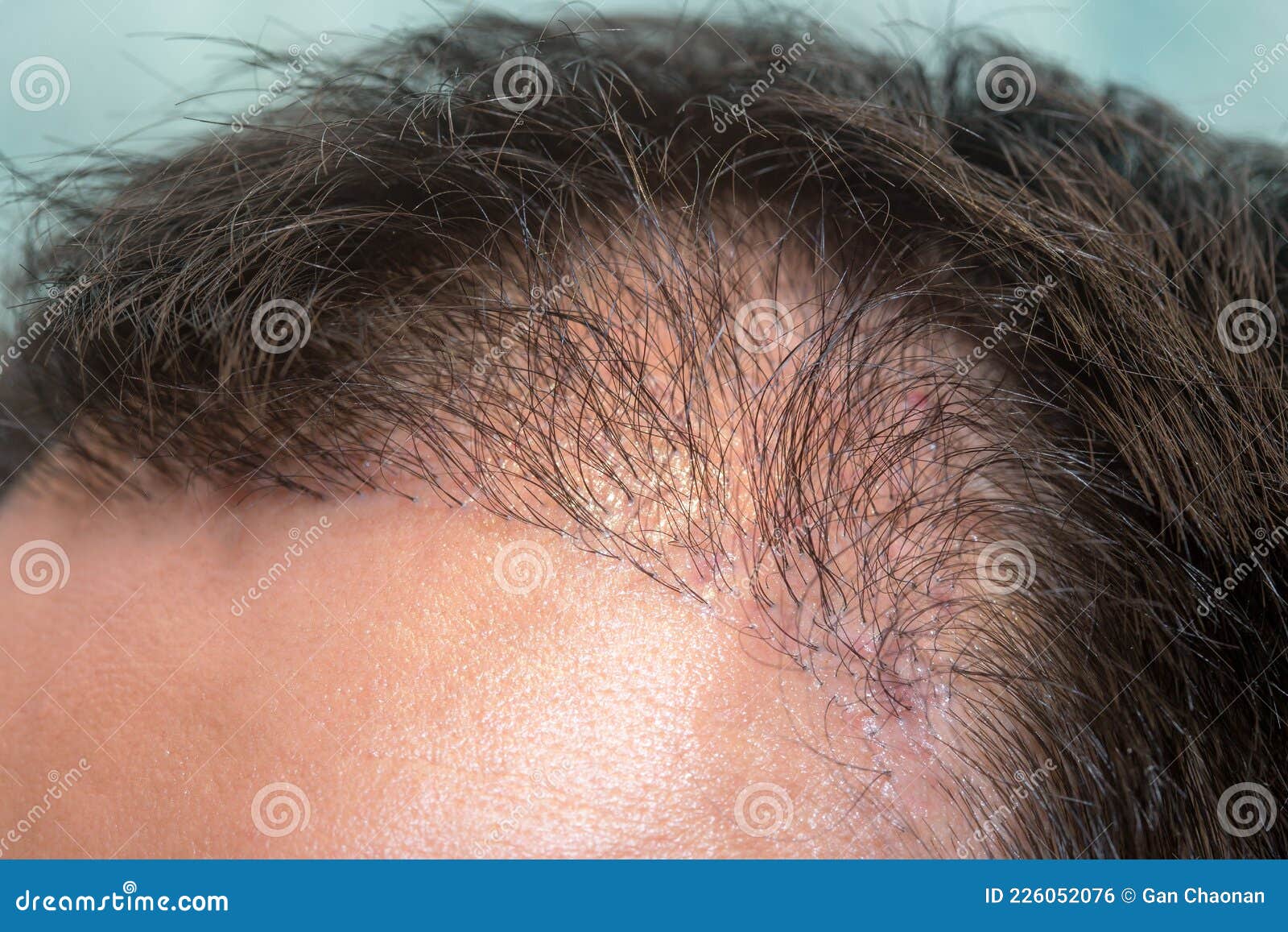 Close Up Top View of a Man`s Head with Hair Transplant Surgery with a  Receding Hair Line Stock Photo - Image of closeup, head: 226052076