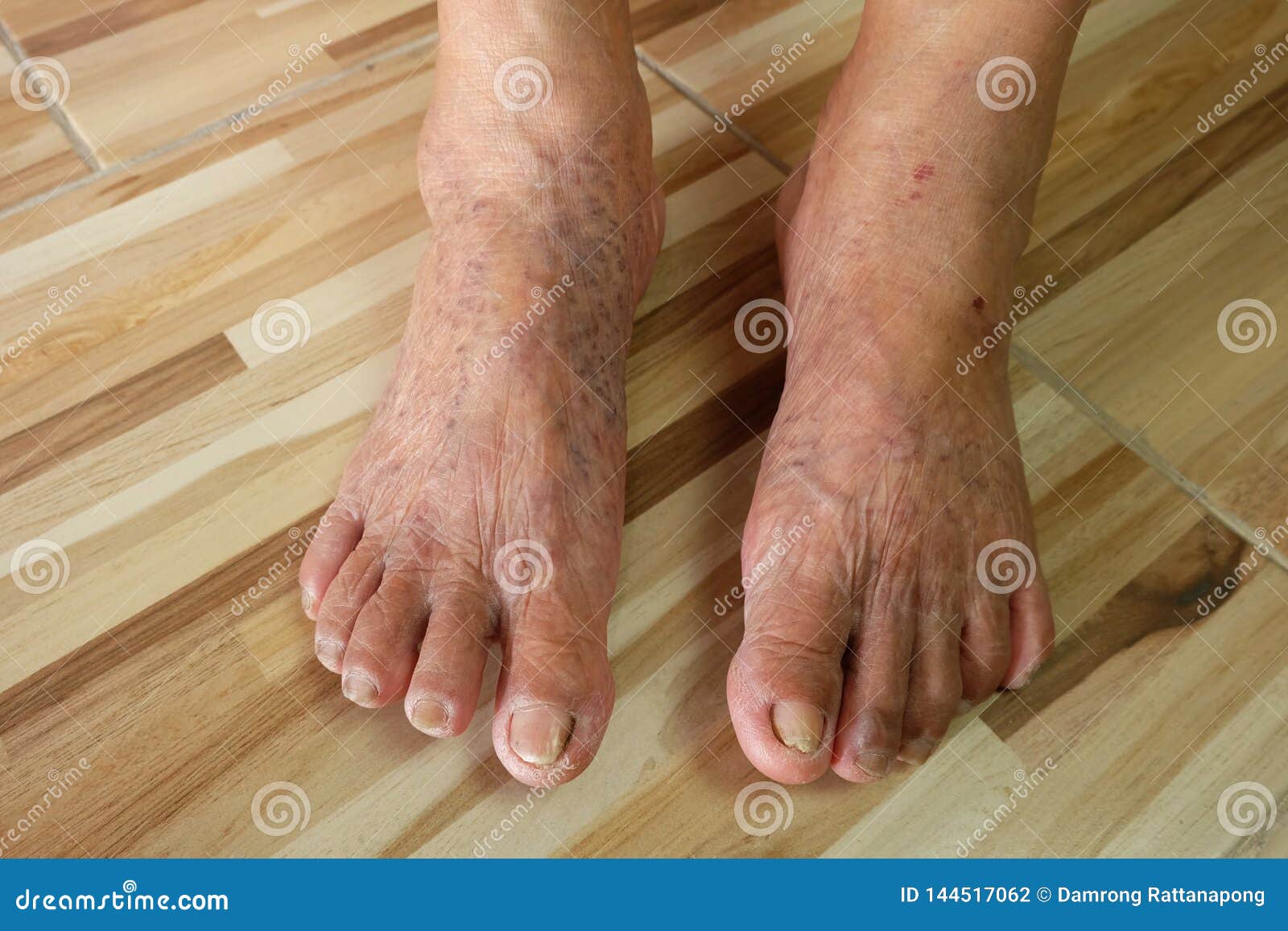 review-uri varicose feet