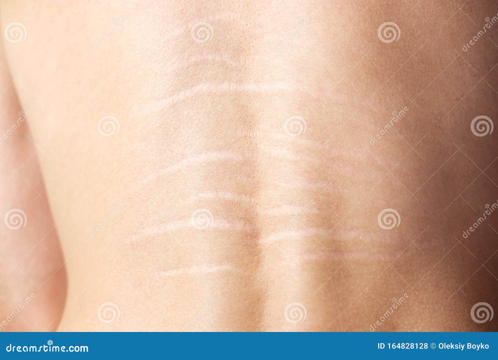 Close up view of the back with .stretch marks on the skin. The concept of  impaired skin elasticity during puberty Stock Photo