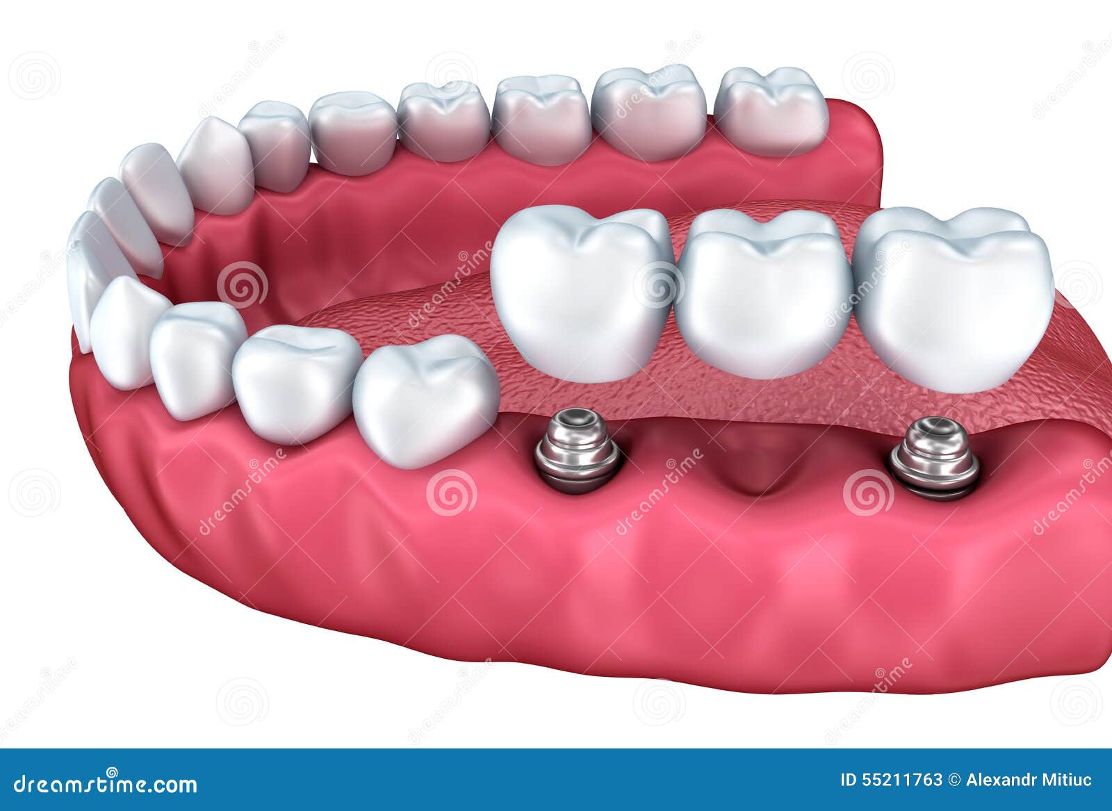 A Closeup View of Lower Teeth and Dental Implants Stock Illustration Illustration of enamel