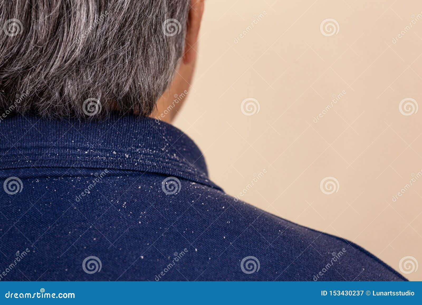 close-up view of a man who has a lot of dandruff from his hair on his shirt and shoulders
