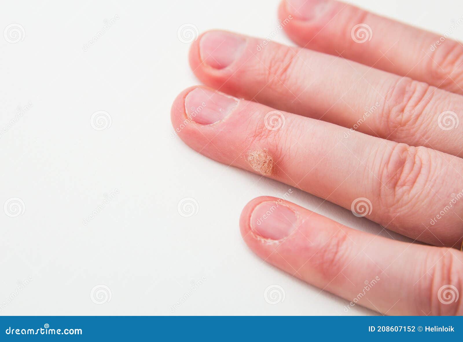 Hpv wart in finger, Papilloma on finger