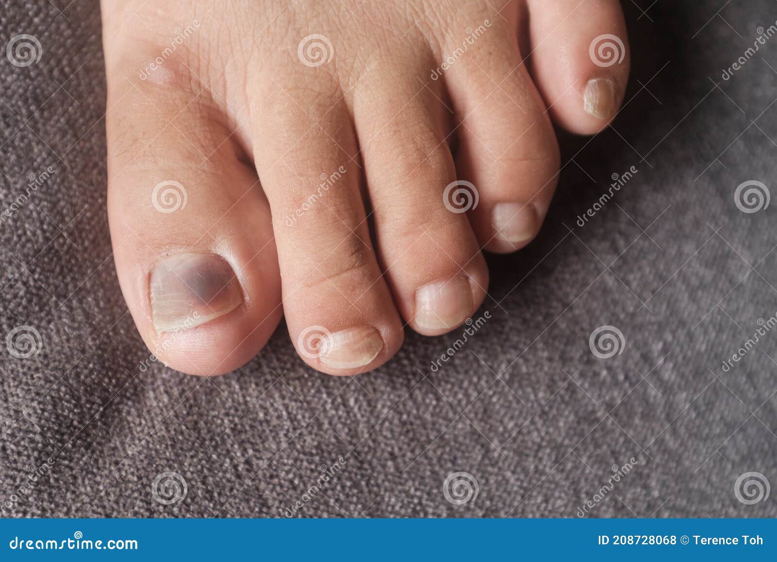 Toe nail fungus toenail trauma Foot injury with nail separation from nail  bed Stock Photo  Alamy
