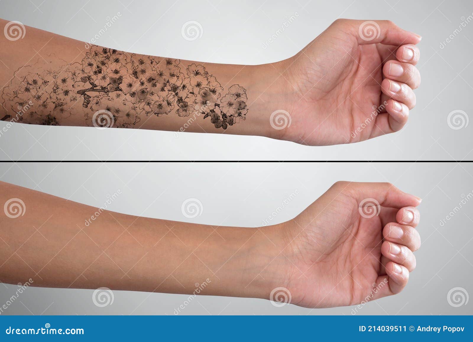 Woman`s Hand before and after Laser Tattoo Removal Stock Image - Image of closeup, lips: 214039511 Woman`s Hand before and after Laser Tattoo Removal Stock Image - Image of closeup, lips: 214039511