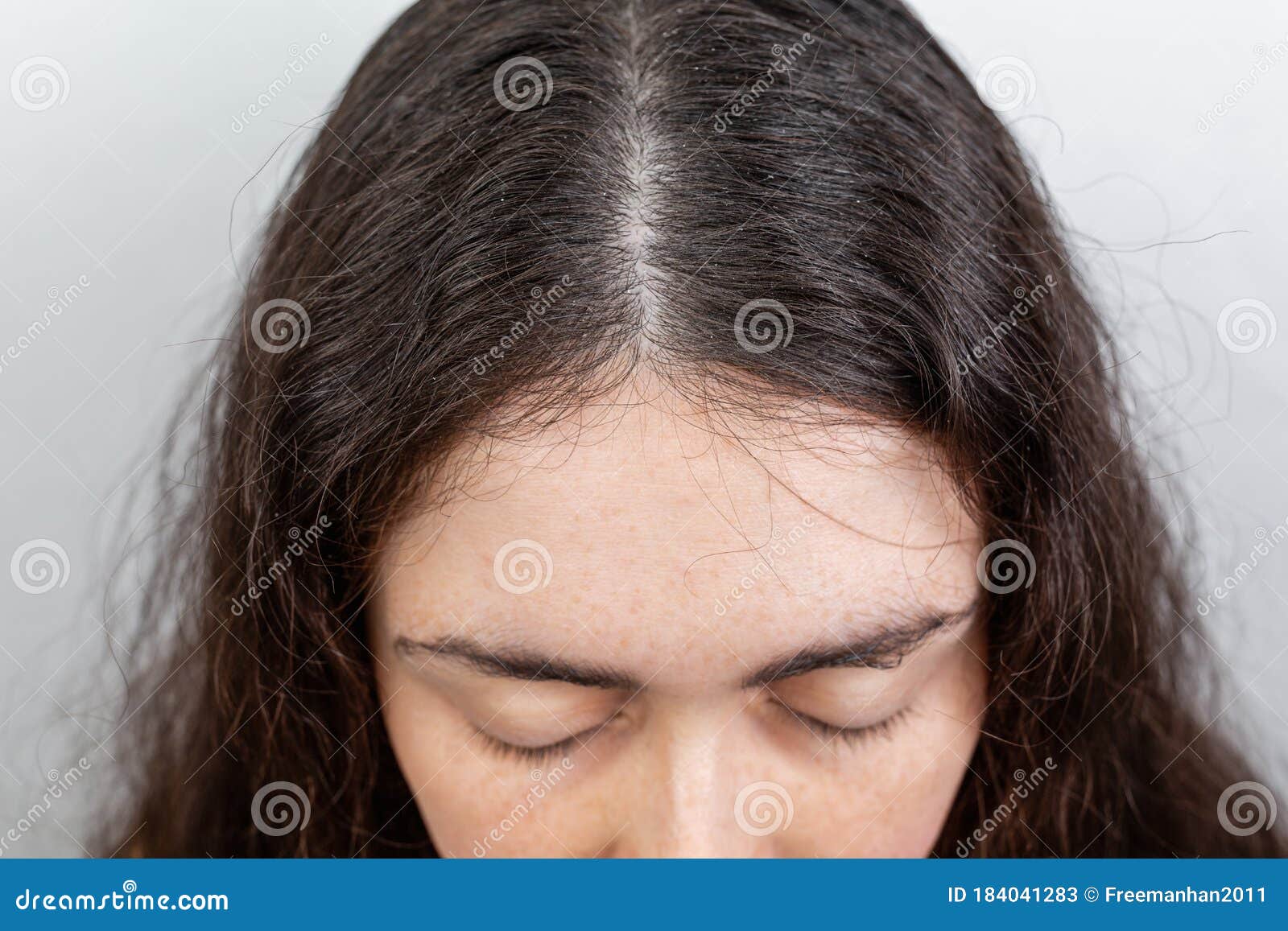 white scalp in hair)