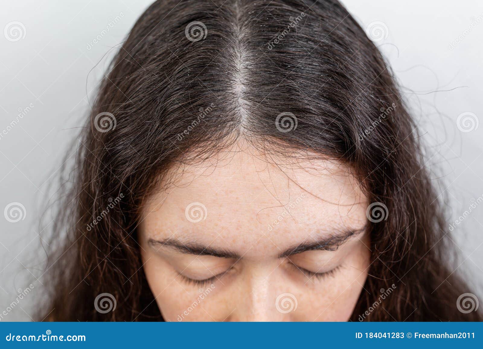 white scalp in hair