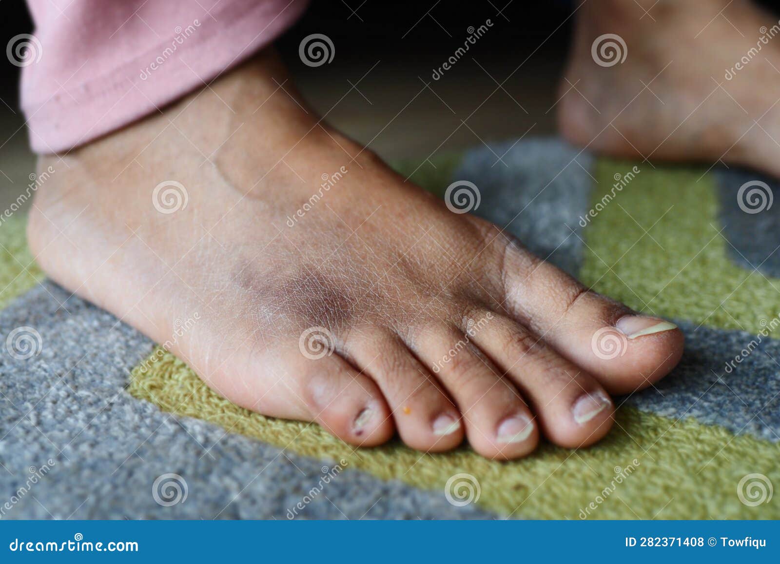 Close Up of Women Feet with Swelling Stock Photo Image of life, ugly