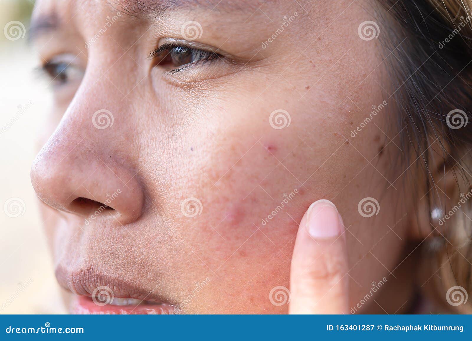 close up of women freckle, dark spot on face, dried skin issues, need treatment. asian middle age women