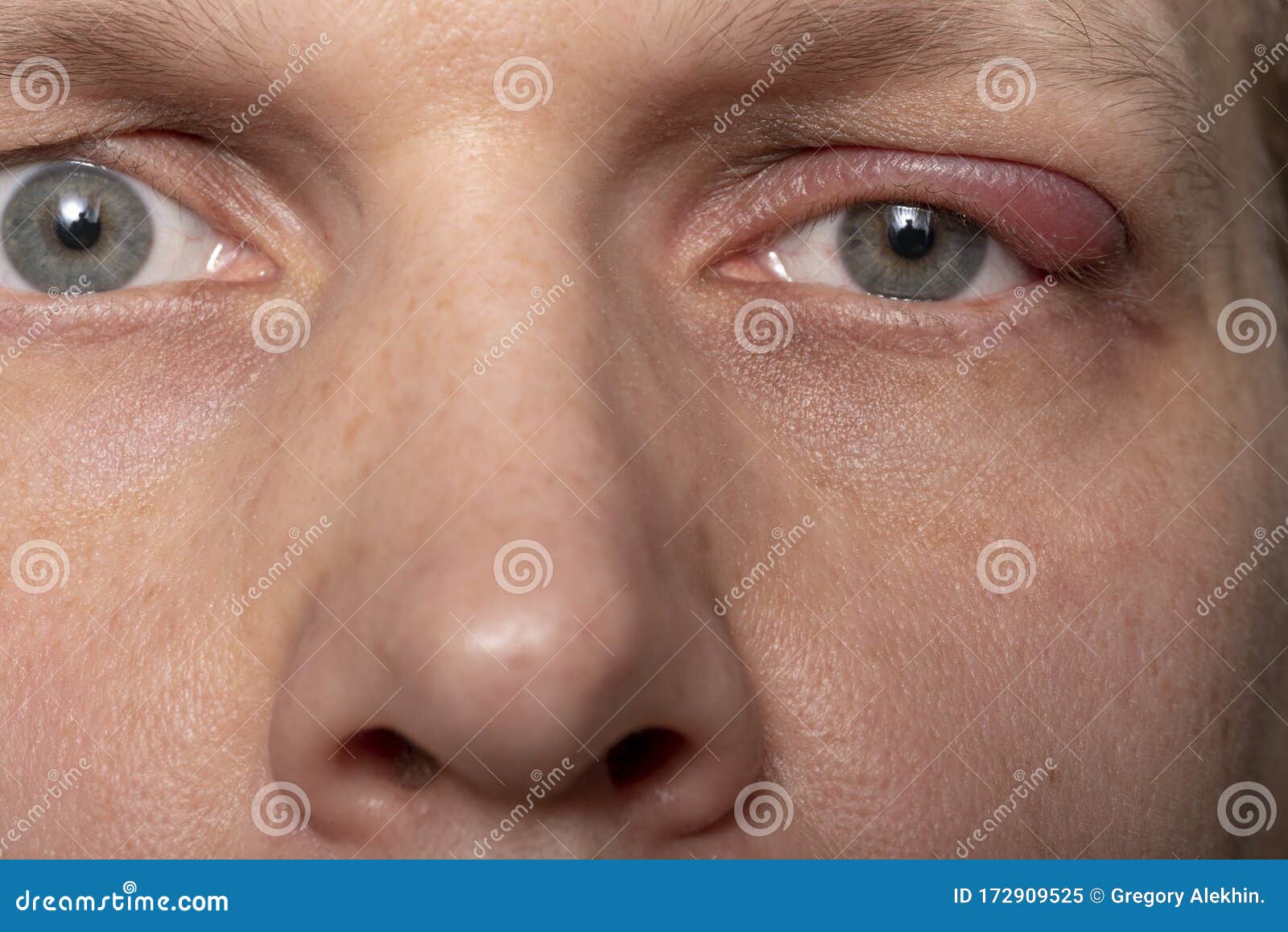 Close the Upper Left Eyelid Abscess. Eye with Barley Stock Image Image of closeup, face 172909525