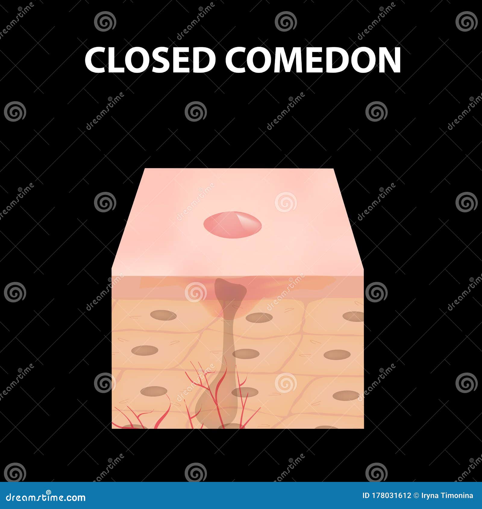 Closed Comedones. Acne on the Skin. Dermatological and Cosmetic ...