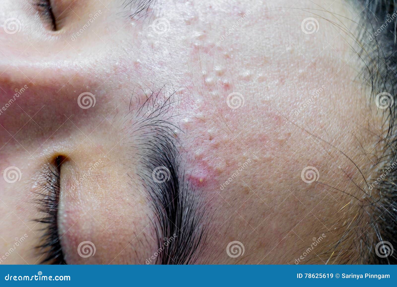closeup acne face women